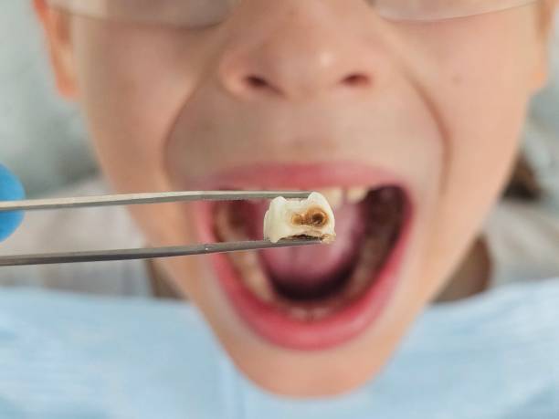 Best Emergency Root Canal Treatment in Citrus Springs, FL